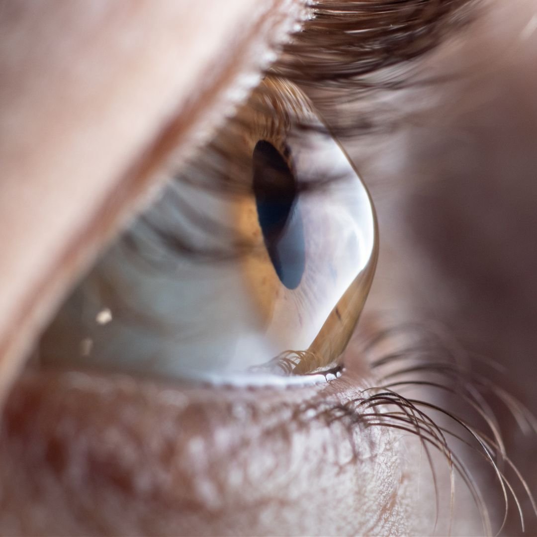 Cirurgia de Ceratocone em Curitiba