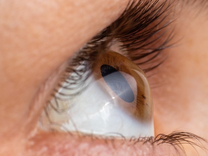 Ceratocone em Curitiba