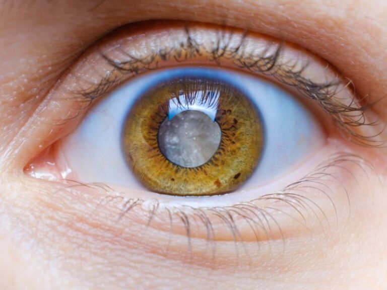 Cirurgia de Catarata em Curitiba