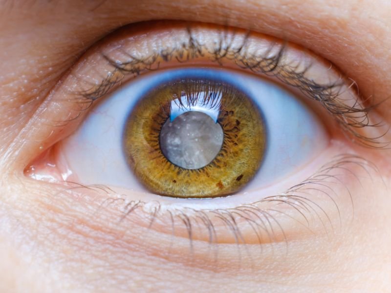 Cirurgia de Catarata em Curitiba