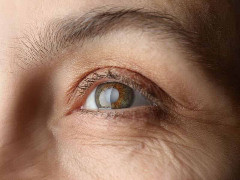 Especialista em Catarata em Curitiba