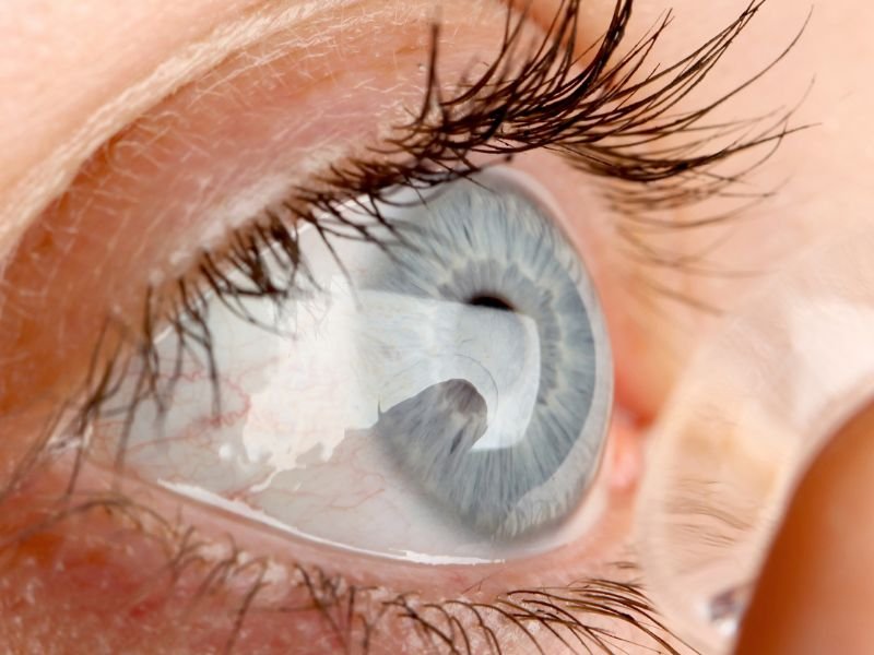 Lente Facica para Miopia em Curitiba