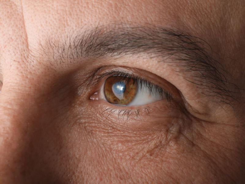 Lente Intraocular para Catarata em Curitiba